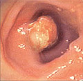 Colonic polyp.jpg