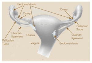 Endometriosis nih.gif